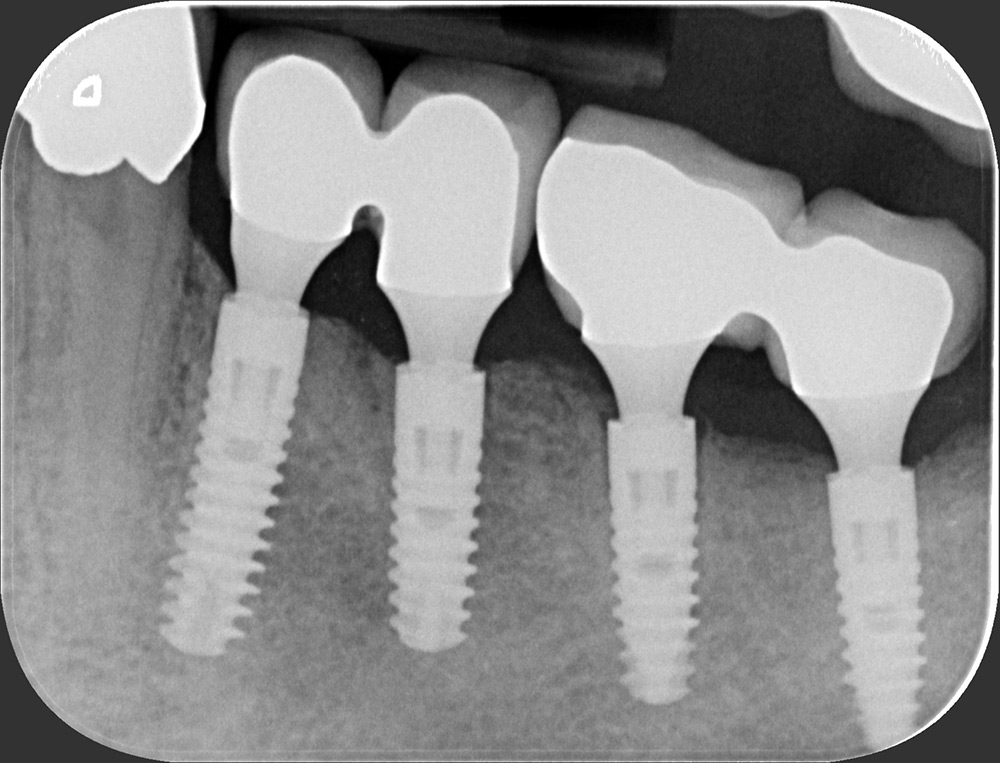 Zahnarztpraxis Heise, Röntgenbild einer Implantat-Versorgung