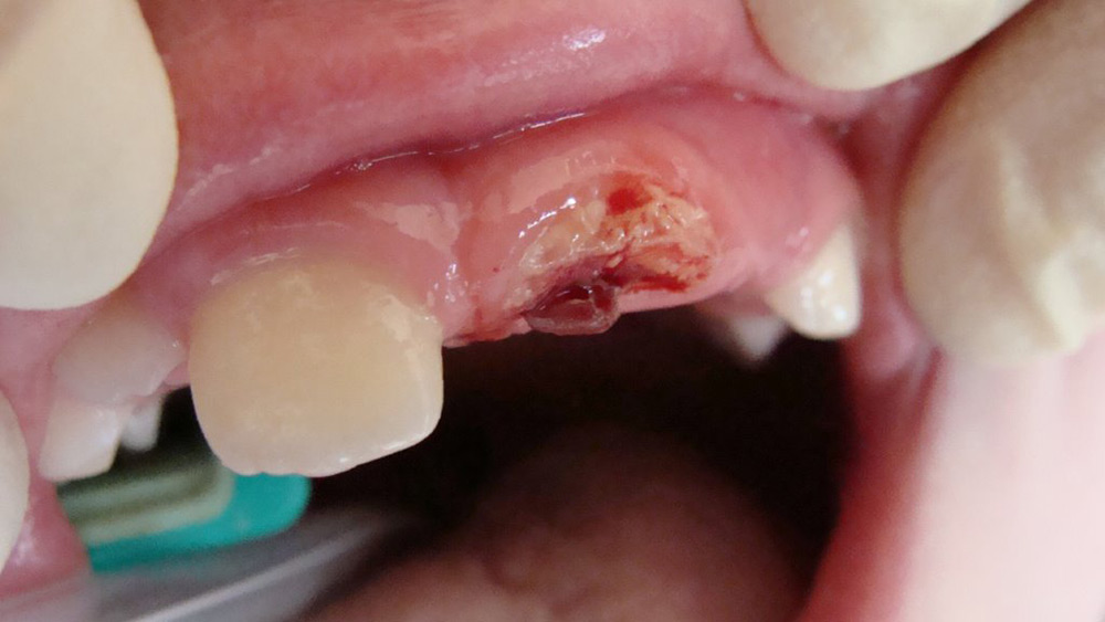 Wurzelbehandlung; Foto vorher: abgeschlagener Zahn