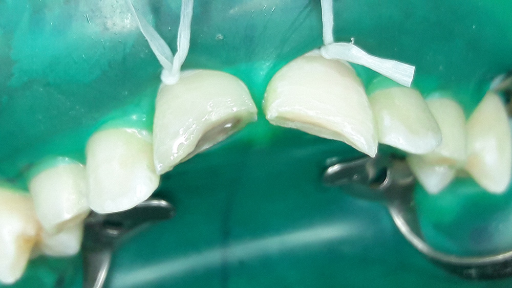 Zahnarztpraxis Heise, ein Zahnunfall vor der Behandlung