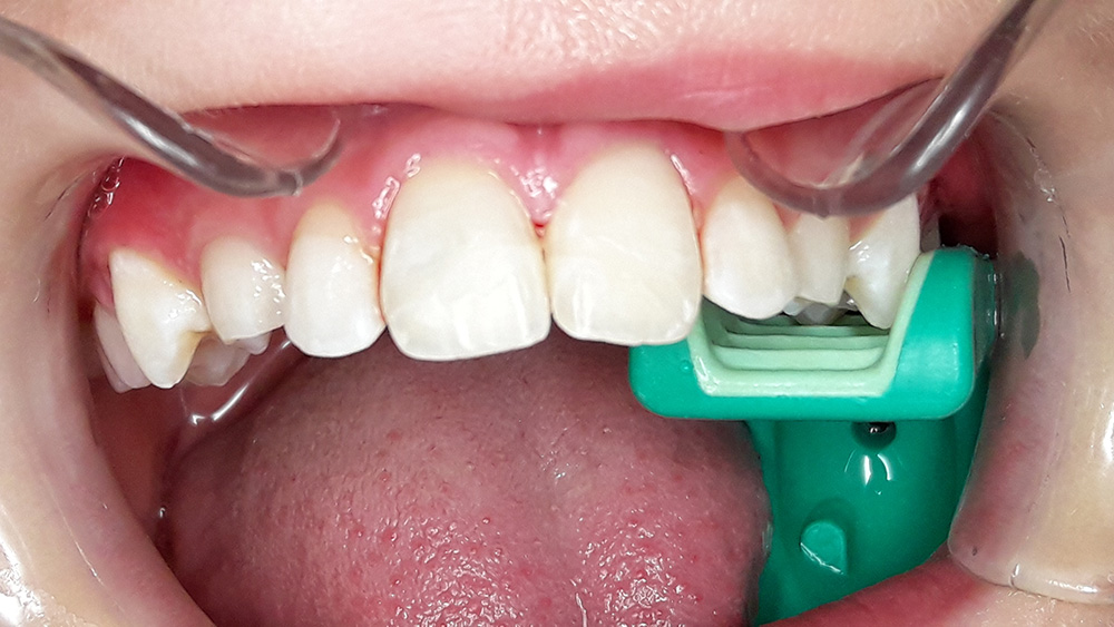 Zahnarztpraxis Heise, ein Zahnunfall nach der Behandlung