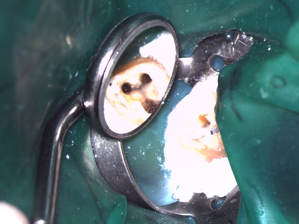 Endodontie: Blick durchs Mikroskop in einen Zahn mit 3 gesäuberten Wurzelkanälen (noch nicht gefüllt)