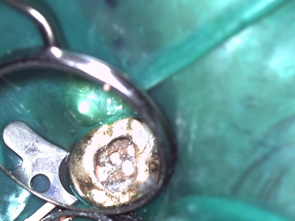 Endodontie: Blick durchs Mikroskop in einen Zahn mit 4 gefüllten Wurzelkanälen